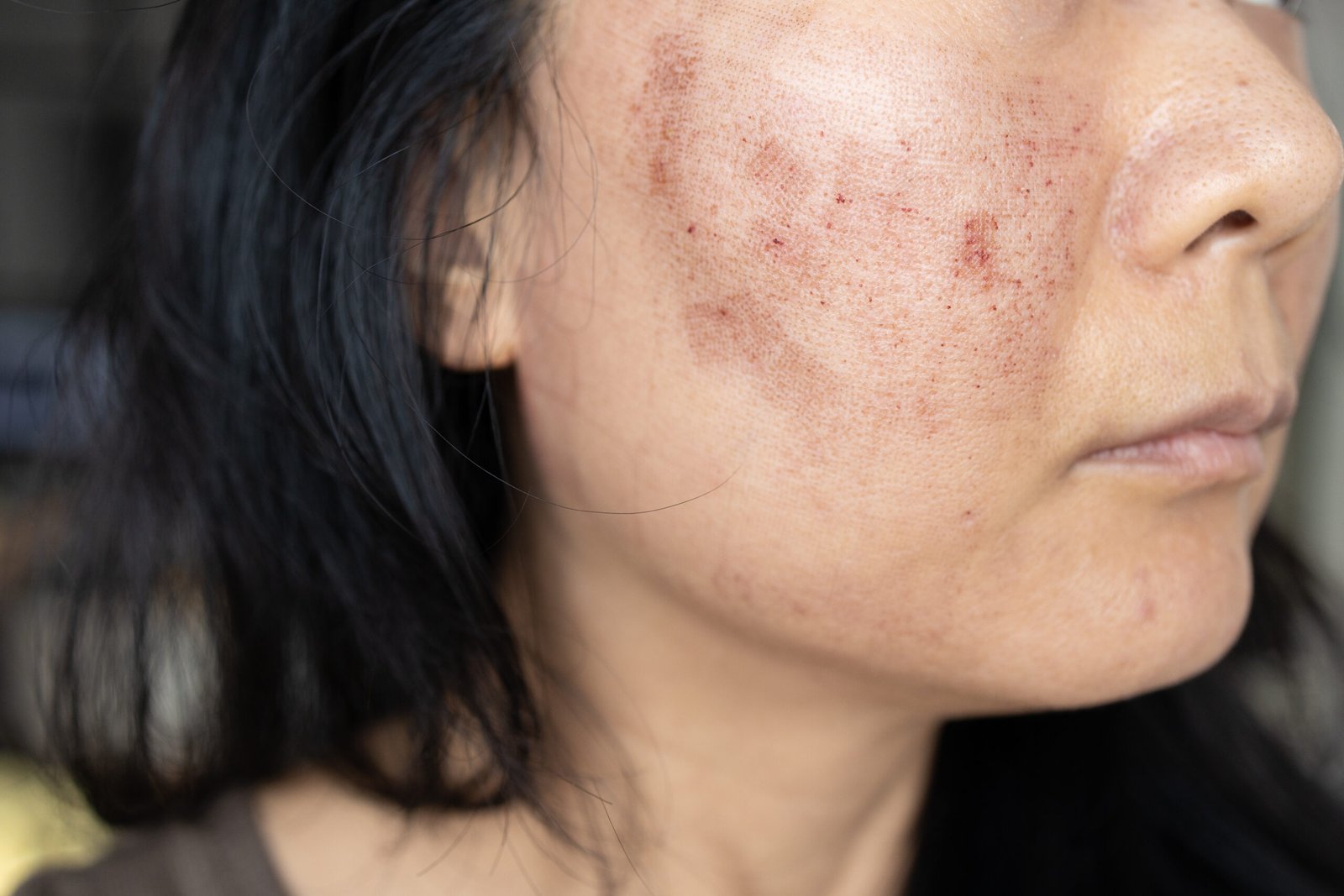 Asian woman's face after facial skin treatment at Couture Dermatology
