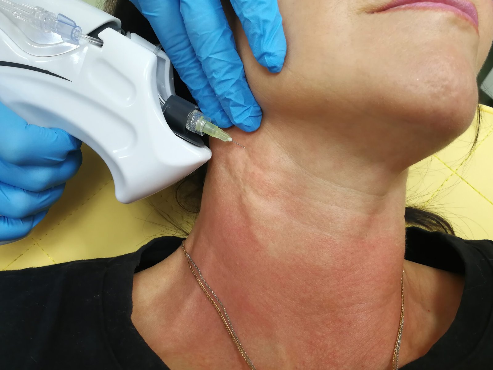 Energy-based skin tightening treatment session at Couture Dermatology