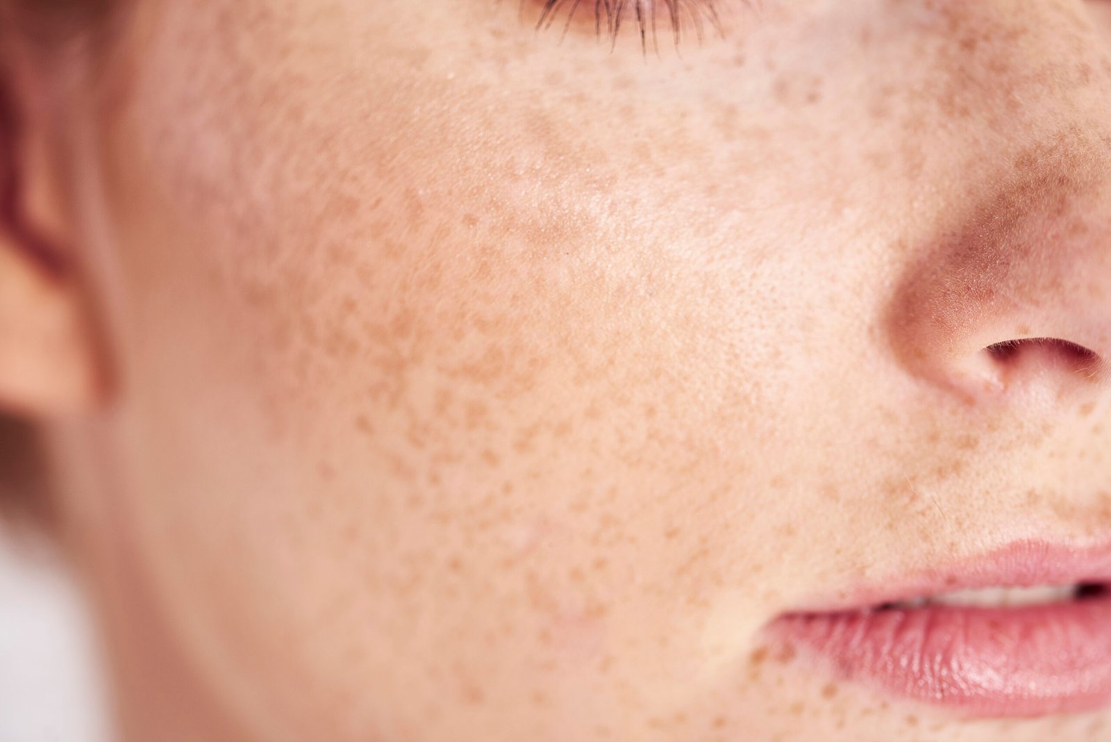 Close-up of woman's face with skin pigmentation at Couture Dermatology