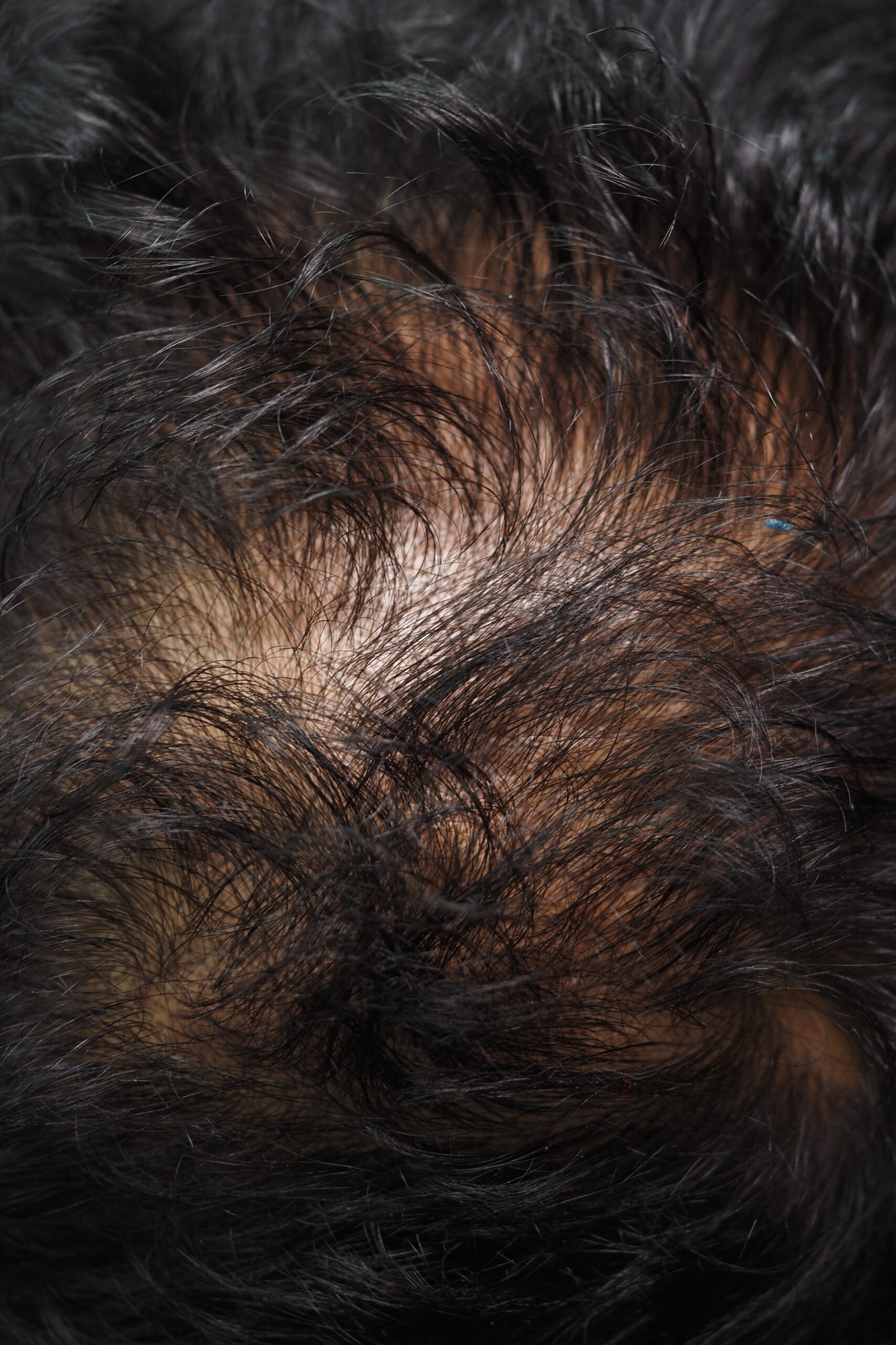 Close-up of scalp showing hair loss pattern at Couture Dermatology Beverly Hills