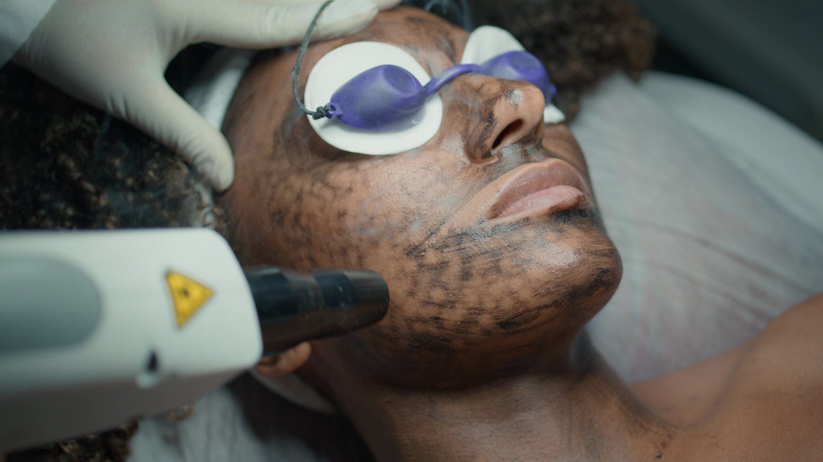 Close-up of fractional laser resurfacing procedure at Couture Dermatology Beverly Hills
