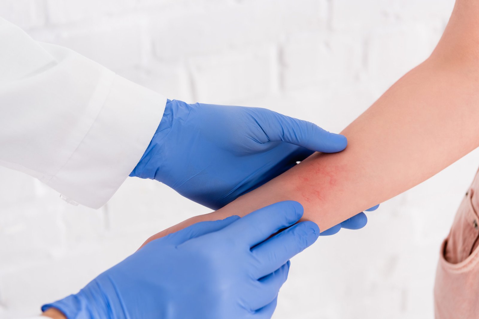 Dermatologist examining a patient's arm with eczema at Couture Dermatology Beverly Hills