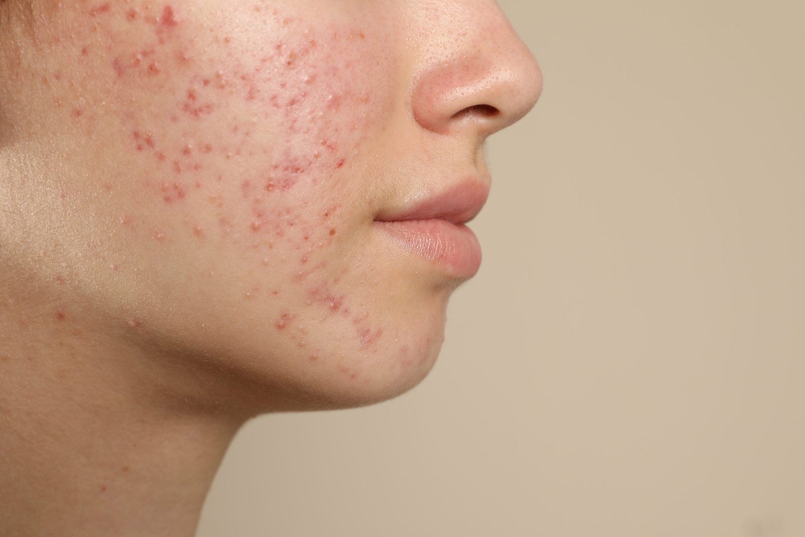 Teenage girl with acne skin showing texture on beige background at Couture Dermatology