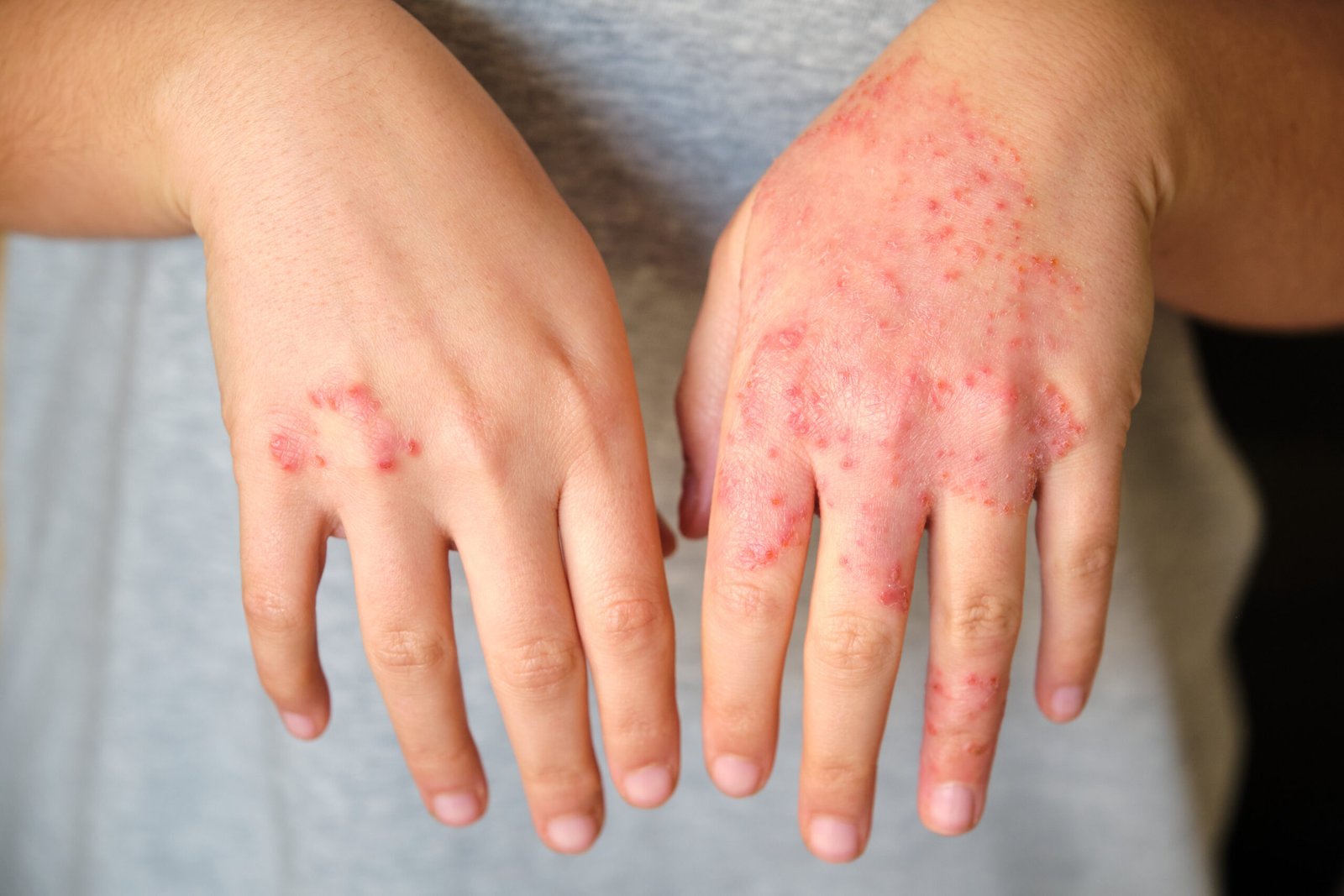 Close-up of eczema and contact dermatitis on hands at Couture Dermatology