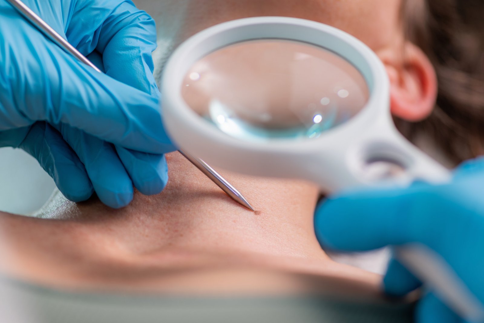 Close-up of dermatological procedure being performed at Couture Dermatology Beverly Hills