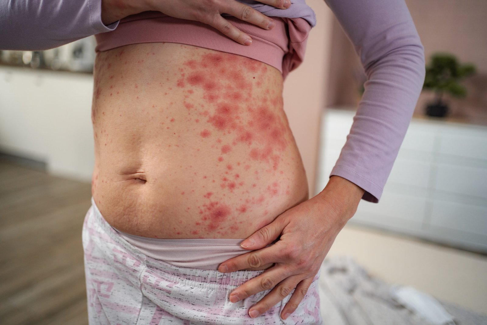 Woman showing red skin rash from allergy at Couture Dermatology Beverly Hills