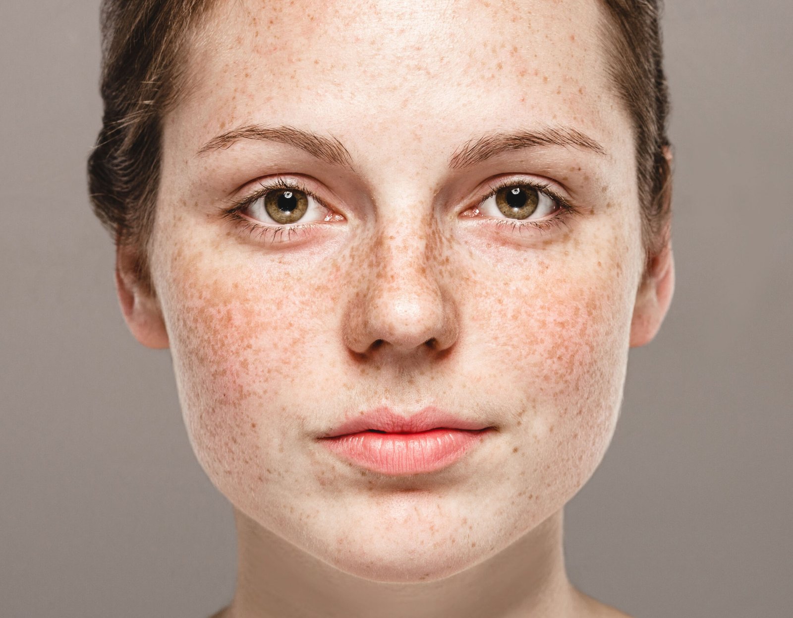 Close-up of skin with hyperpigmentation assessed at Couture Dermatology Beverly Hills