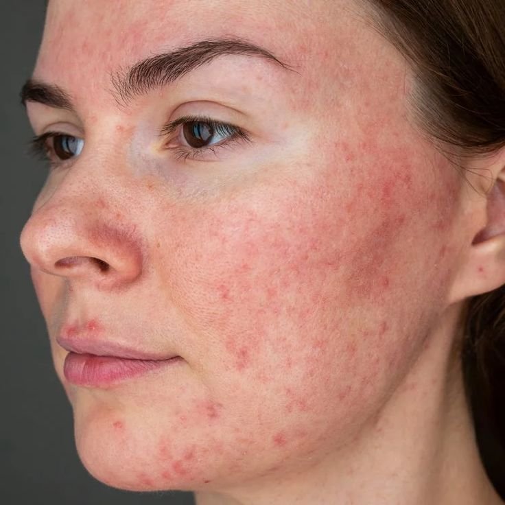 Close-up showing rosacea skin condition at Couture Dermatology